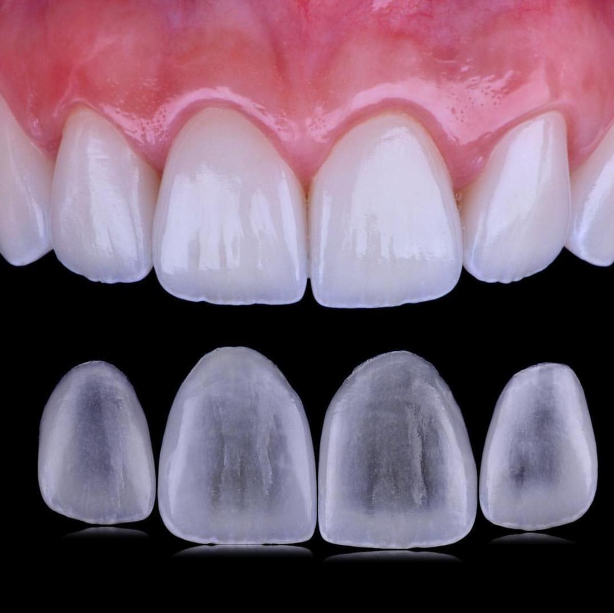 Lentes de contato dentais em porcelana, mostrando espessura e translucidez