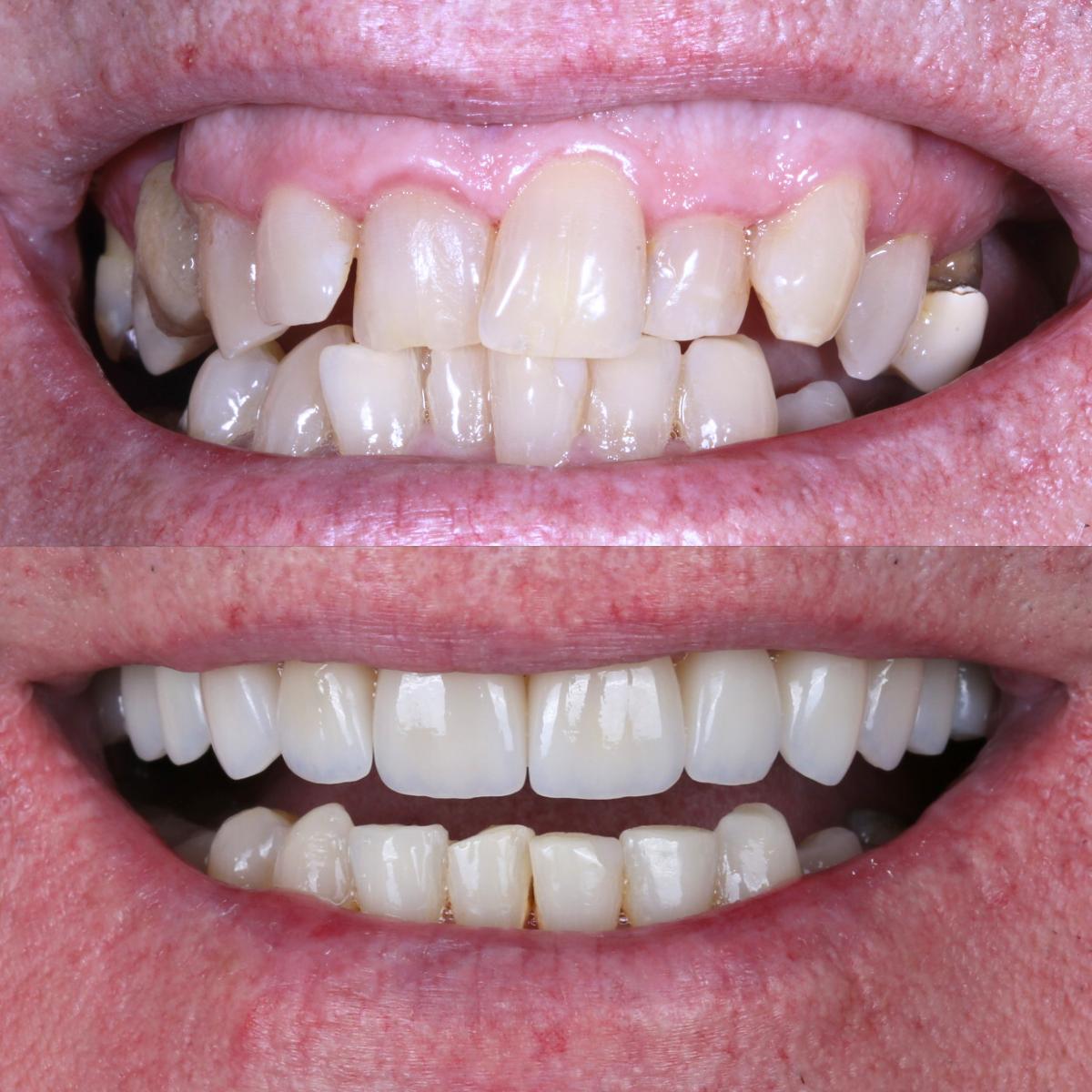 Antes e depois de lentes de contato dentais: dentes desalinhados corrigidos