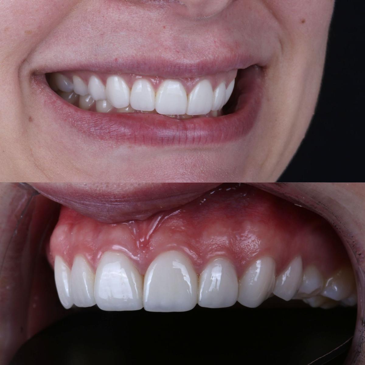 Antes e depois de lentes de contato dentais com sorriso alinhado