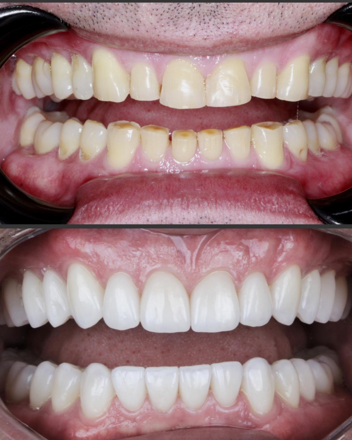 Antes e depois de lentes de contato dentais com harmonização do sorriso