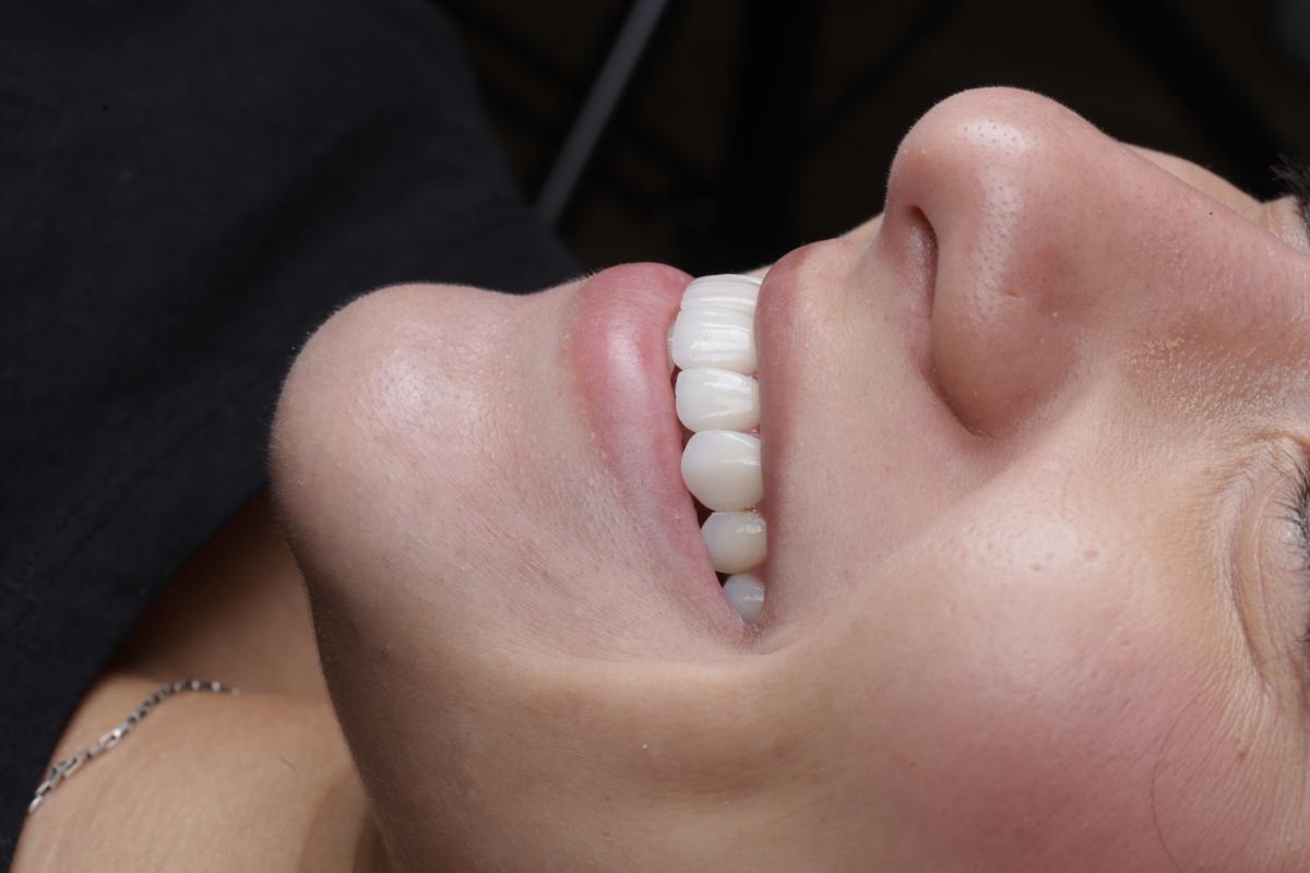 Sorriso finalizado com lentes de contato dentais, vista lateral