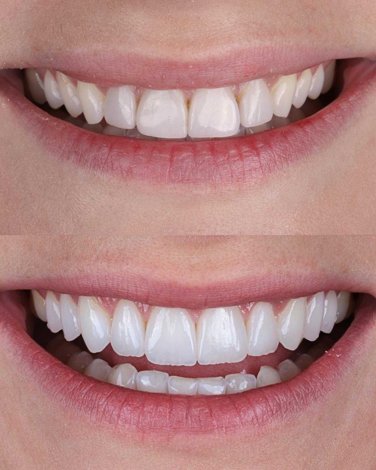 Antes e depois de lentes de contato dentais com correção de forma e cor