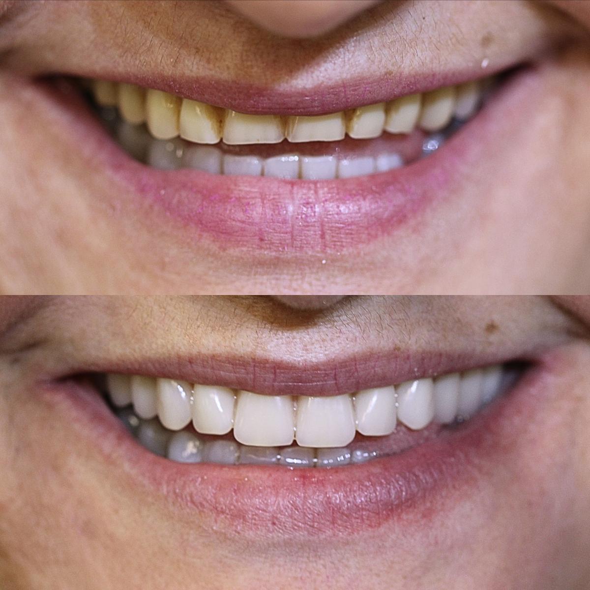 Antes e depois de reabilitação total com protocolo sobre implantes