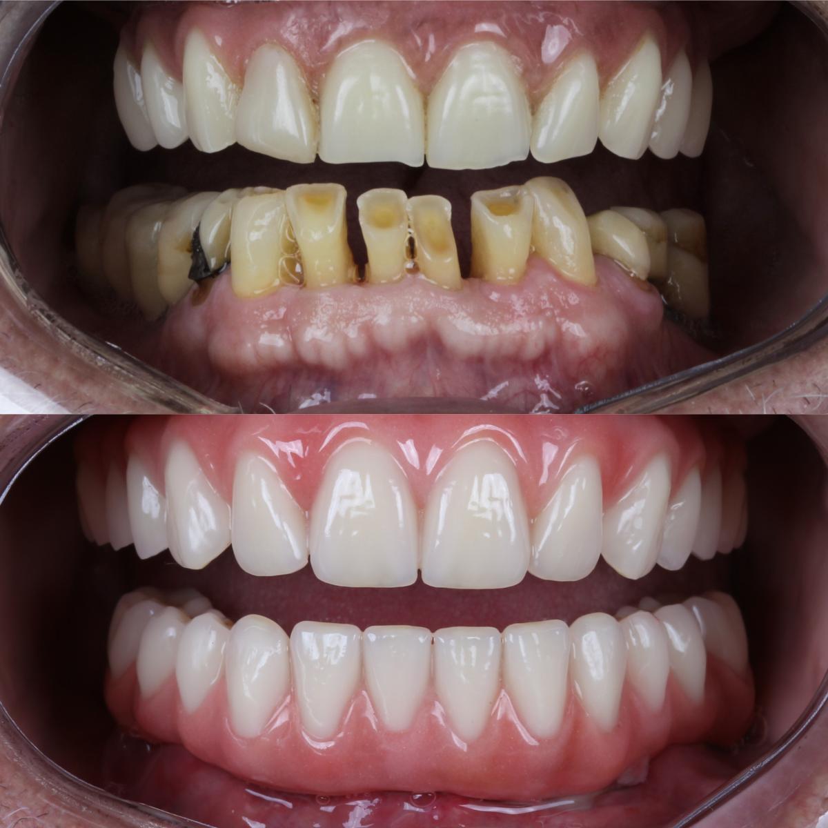 Antes e depois de protocolo sobre implantes: arcada superior reabilitada
