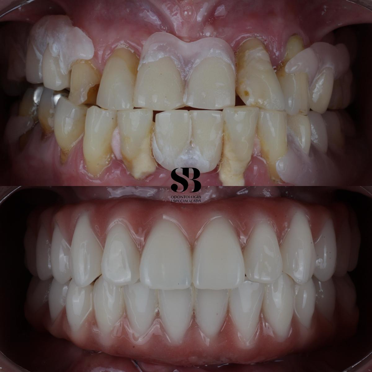 Antes e depois de protocolo sobre implantes com dentes fixos