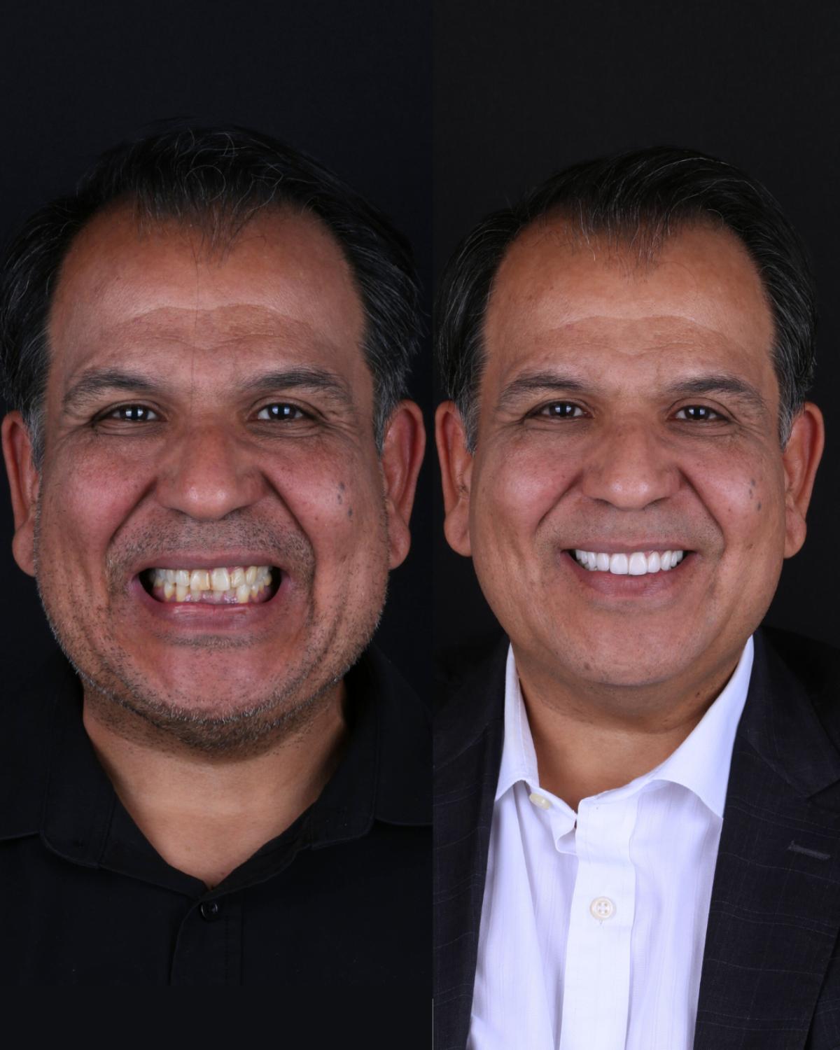 Paciente antes e depois da reabilitação oral, sorriso completo