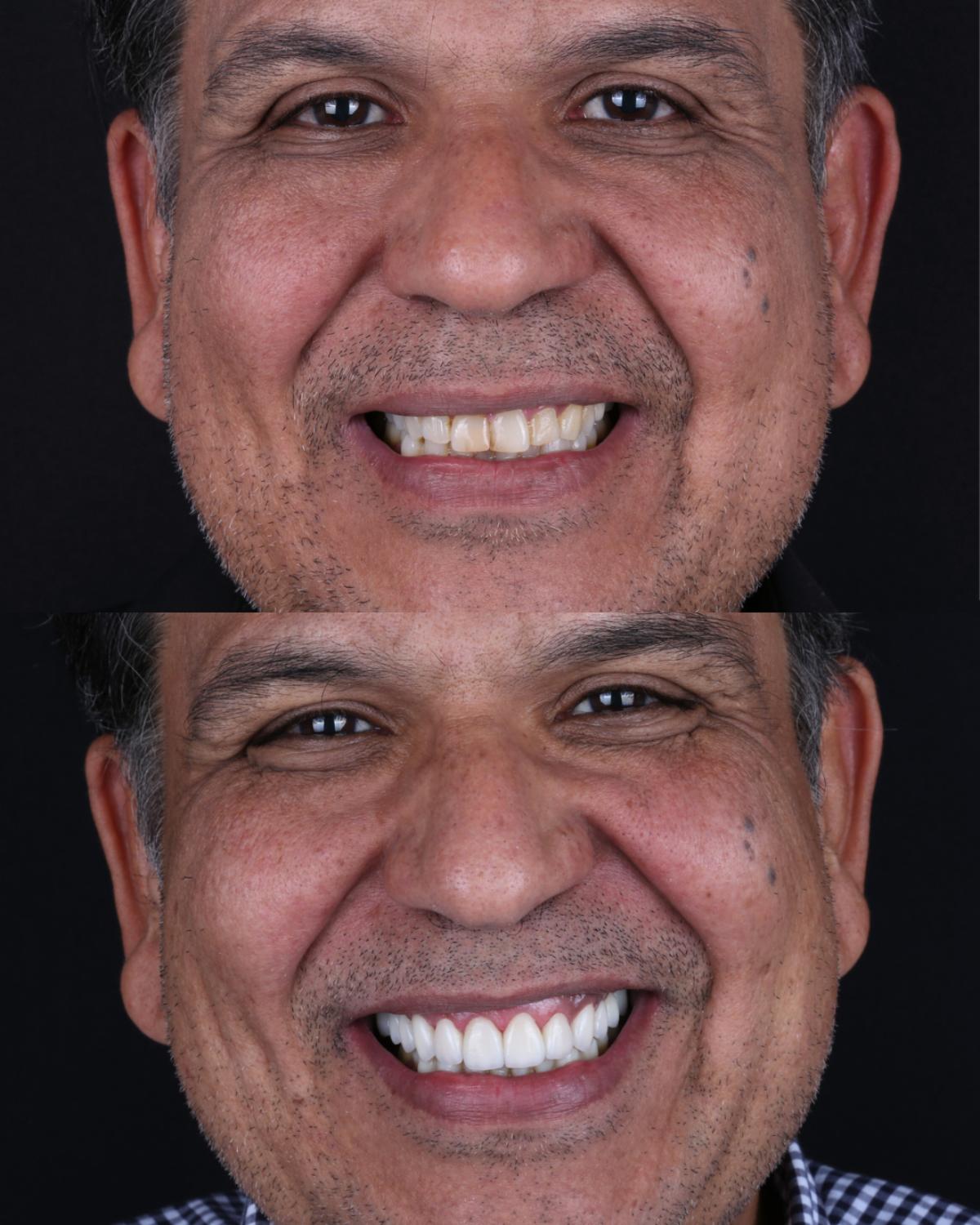 Paciente antes e depois da reabilitação oral, sorriso completo