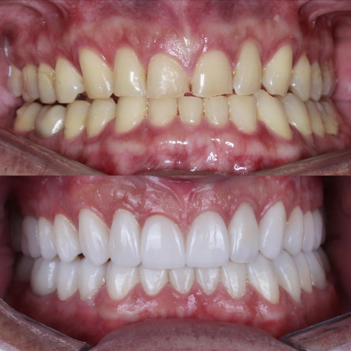 Antes e depois de reabilitação oral com correção de desgaste dental