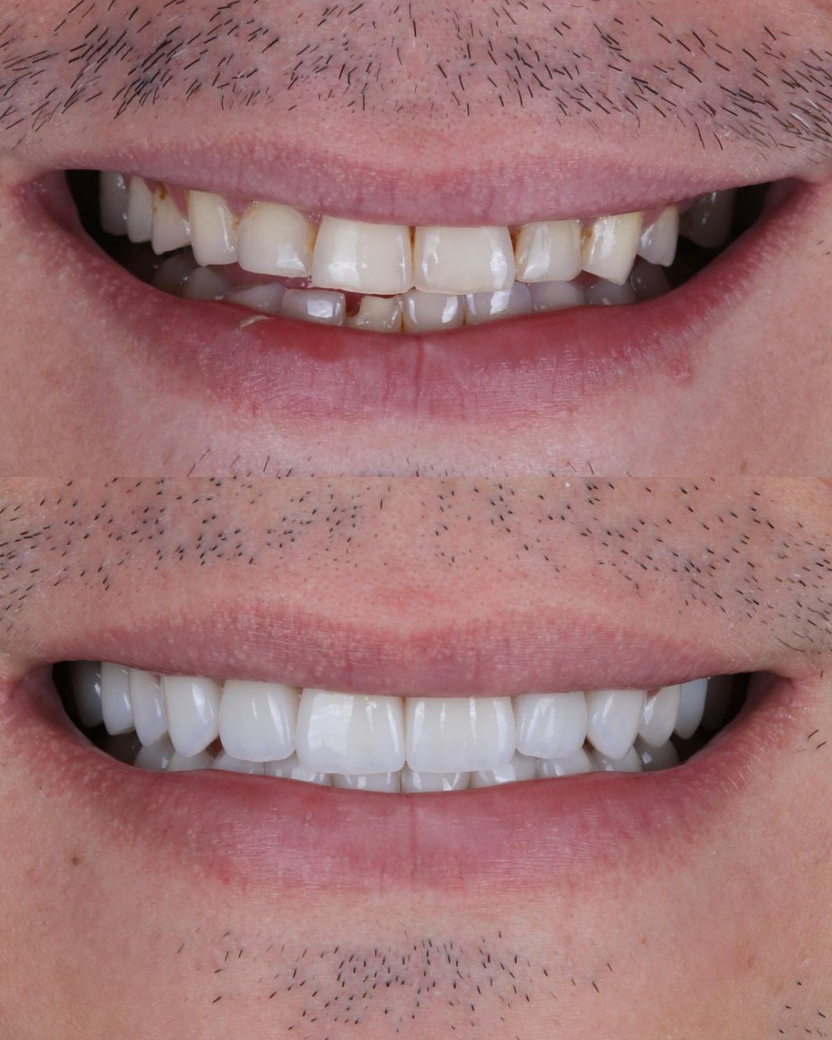 Antes e depois de reabilitação oral com prótese sobre implantes