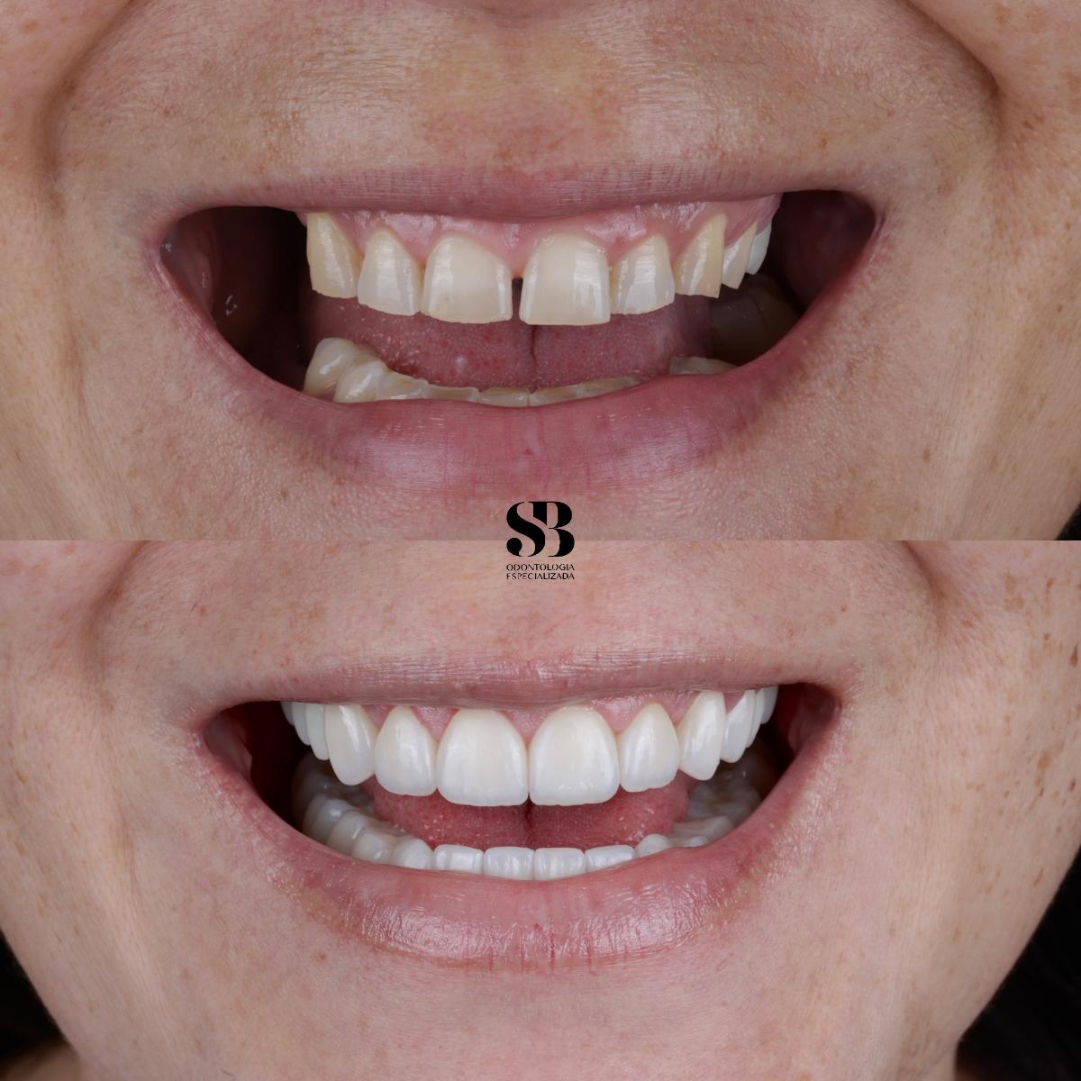 Antes e depois de reabilitação oral com substituição de dentes perdidos