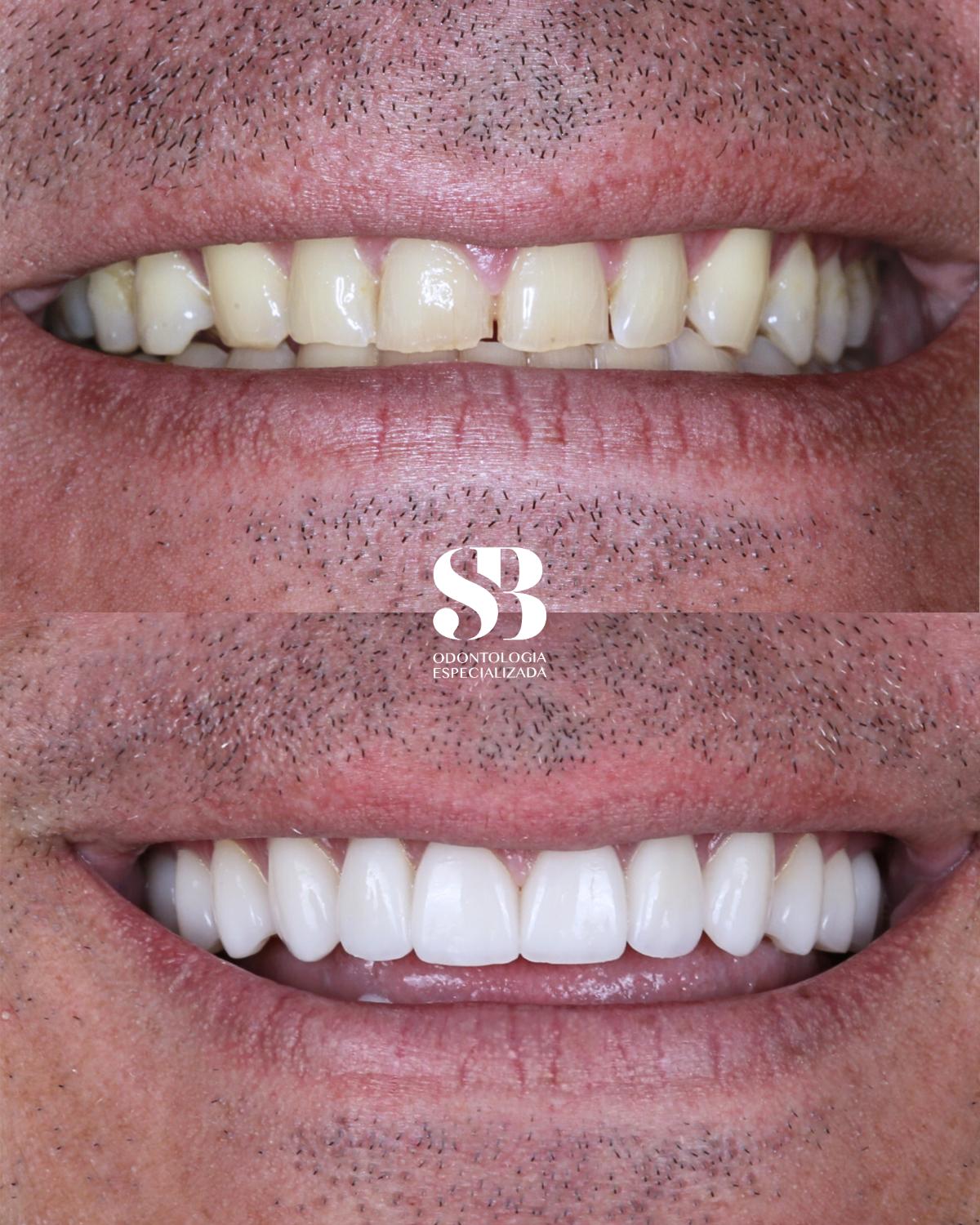 Antes e depois de reabilitação oral com harmonização do sorriso