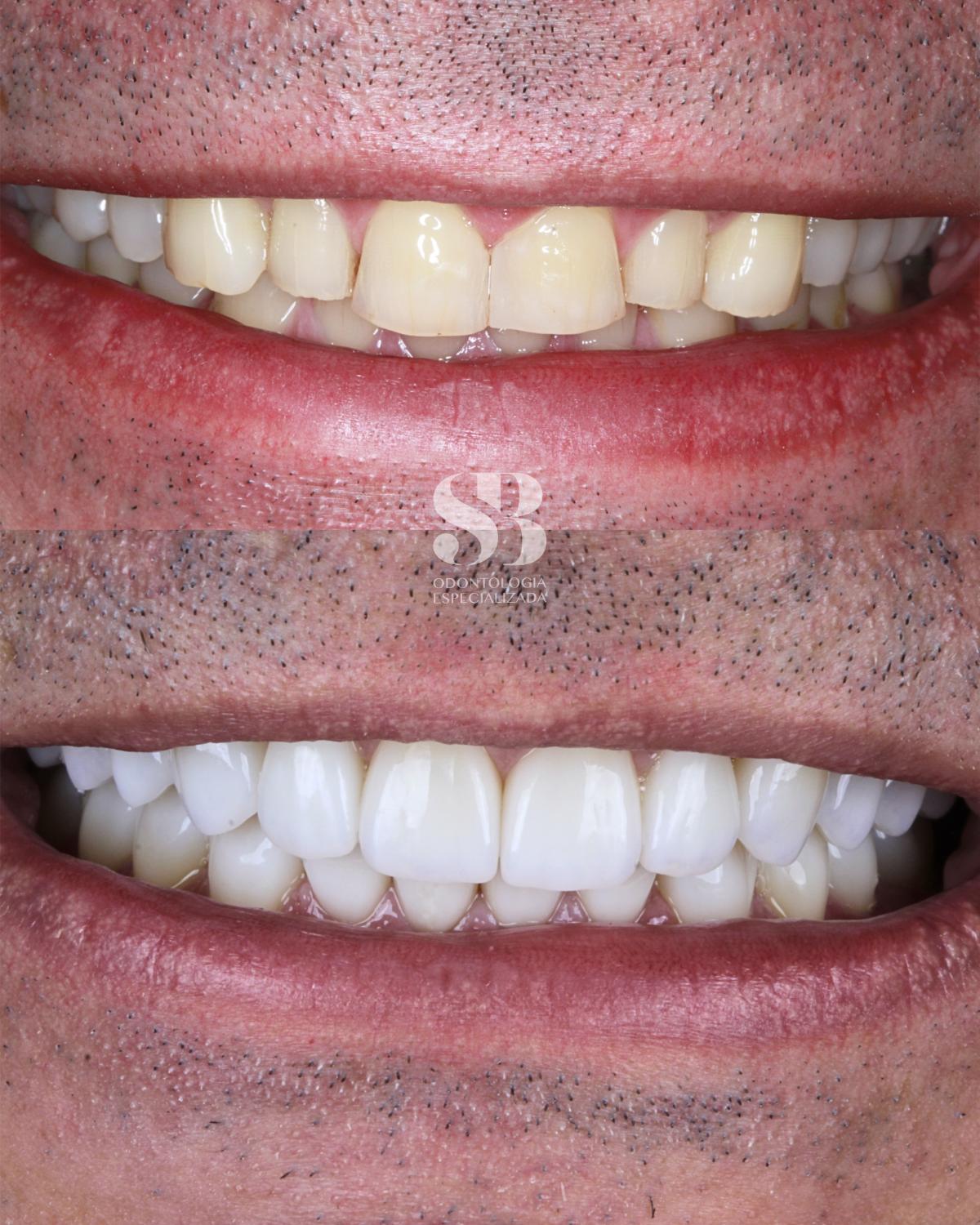 Antes e depois de reabilitação oral com recuperação da forma e da cor