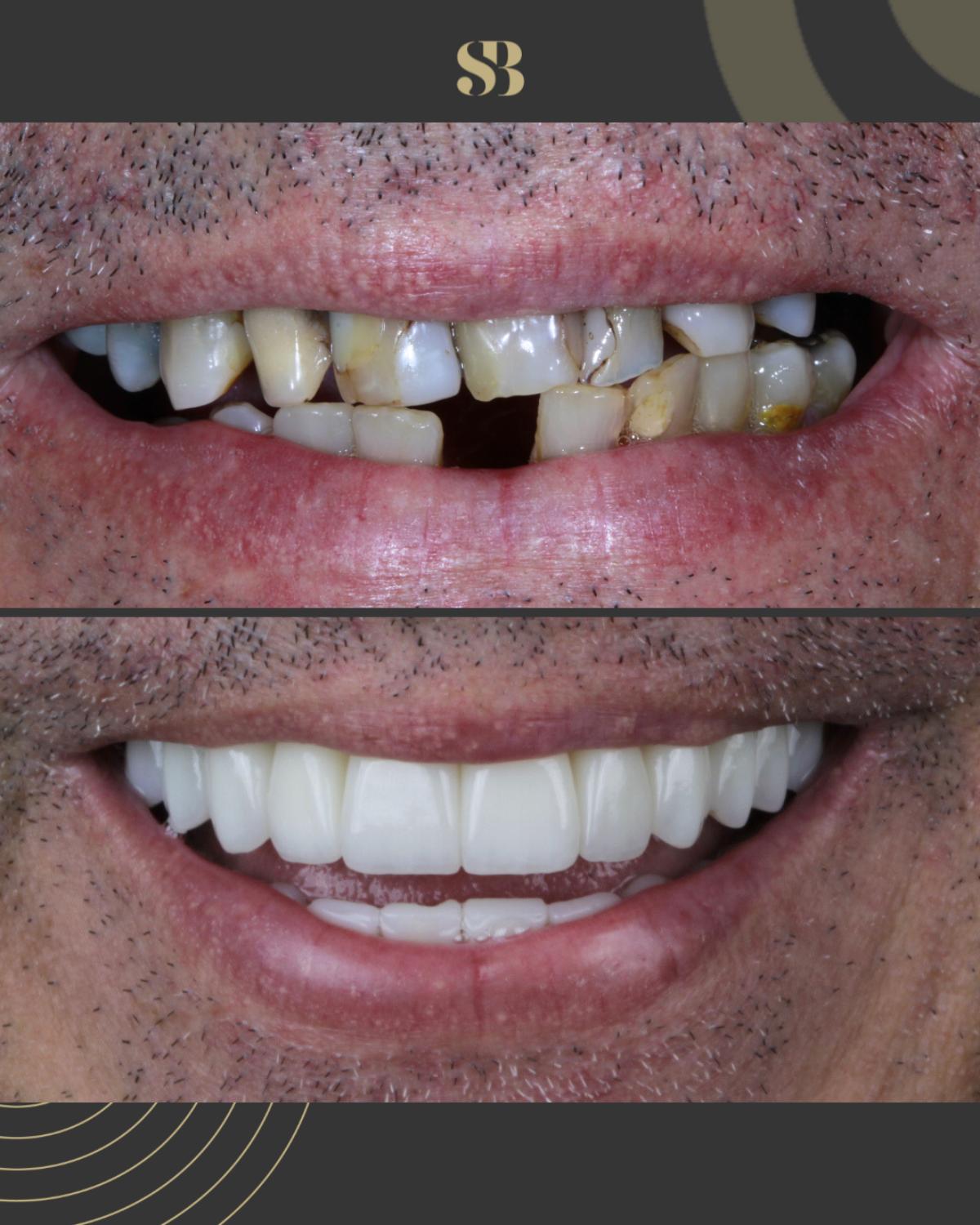 Antes e depois de reabilitação oral em caso de perda dental avançada